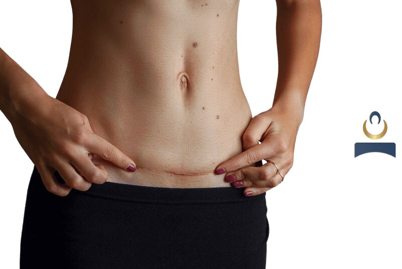 Tummy Tuck Scars in abdomen